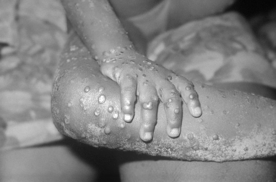 mpox